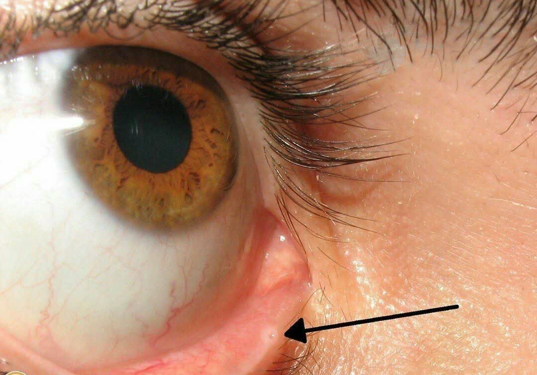 ‏اون سوراخه اسمش لاکریمال پونکتومه