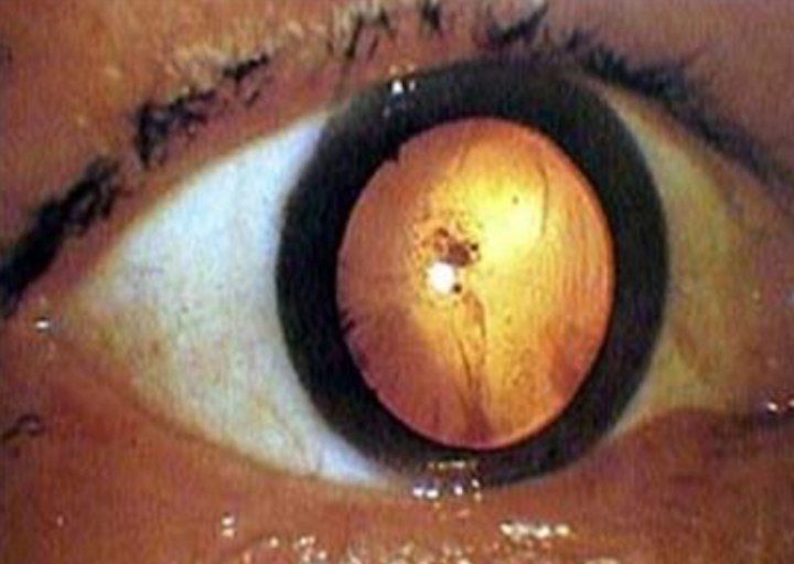 تصویر انفجار بمب اتمی در چشم