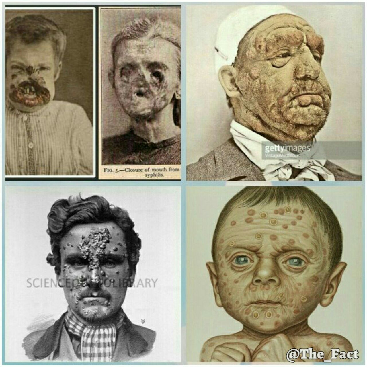 بیماری کوفت