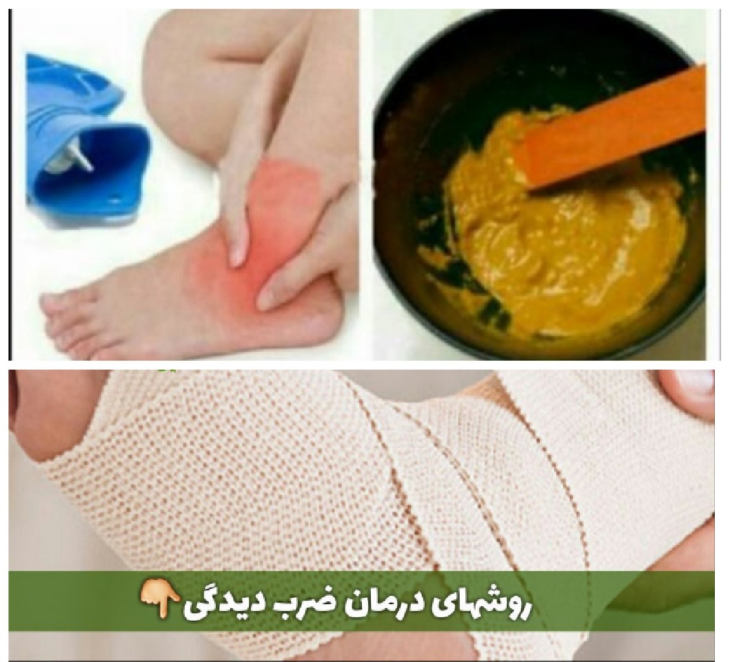 روشهای درمان ضرب دیدگی