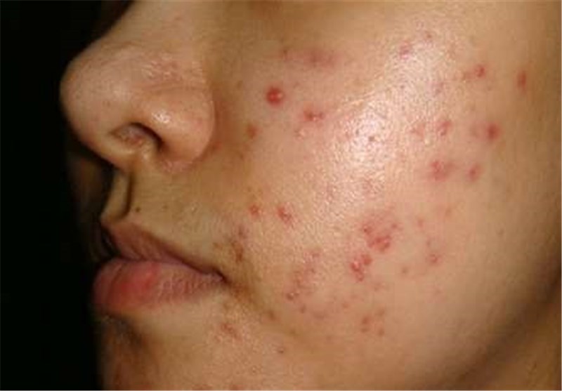 دلایل جوش زدن پوست