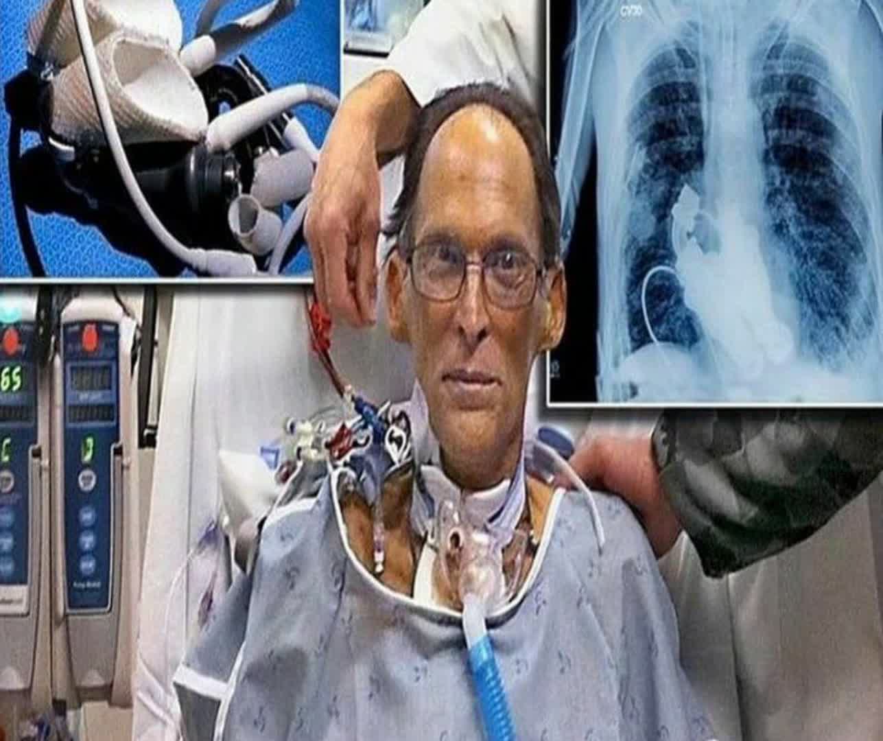 نخستین انسان بدون قلب