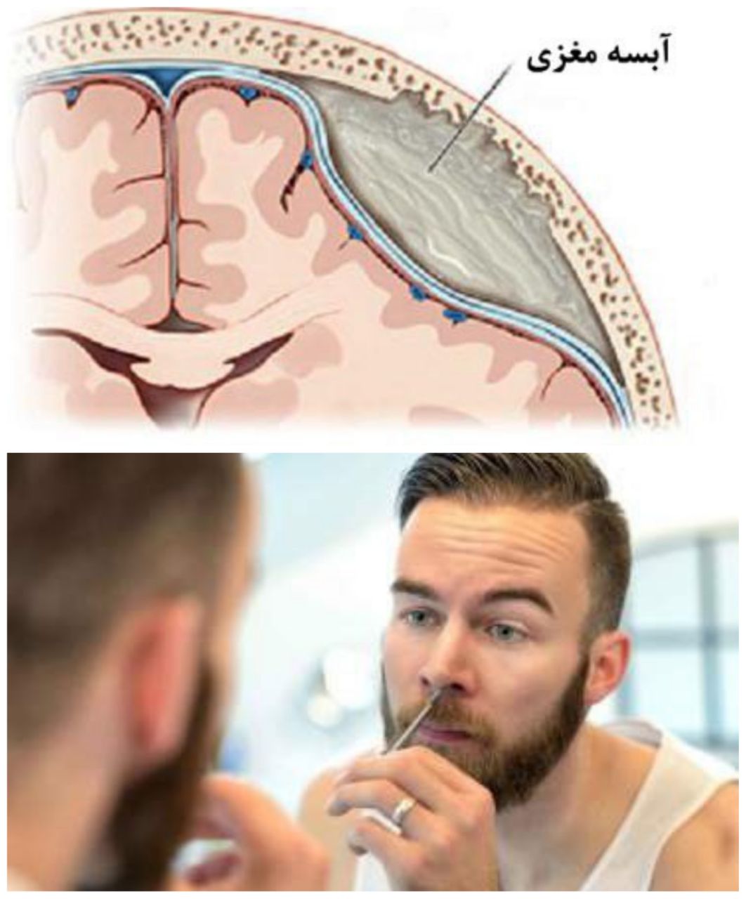 کندن موی بینی باعث آبسه مغزی