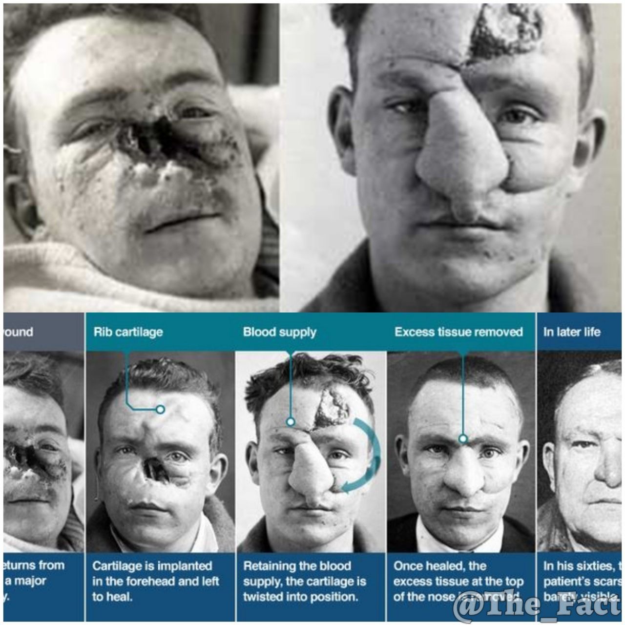 اولین کسی که بینی اش را عمل کرد
