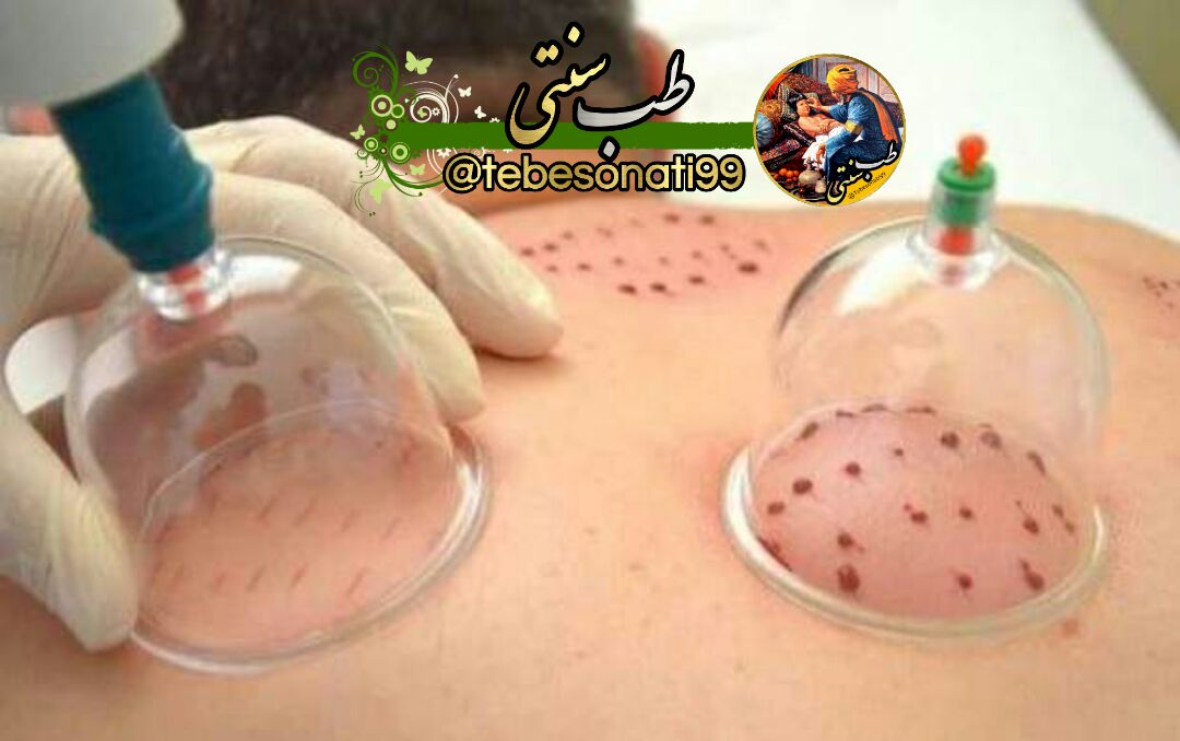 فواید حجامت کردن