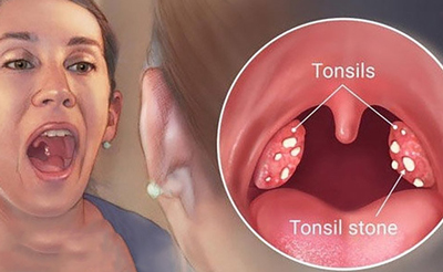 سنگ لوزه چیست؟؟