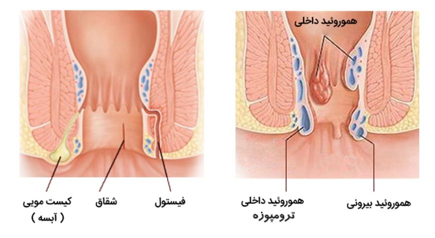 عفونت مقعدی زنان