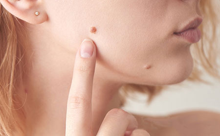 خال گوشتی و راه‌های از بین بردن آن