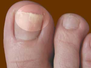 فرو رفتن ناخن پا در گوشت