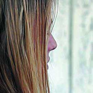 پیوند مو و ۴ سؤال اساسی