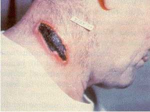 سیاه زخم (شاربن)