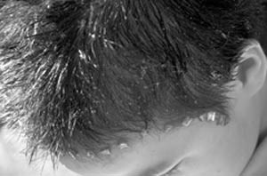 آن‌چه باید درباره شوره سر بدانید