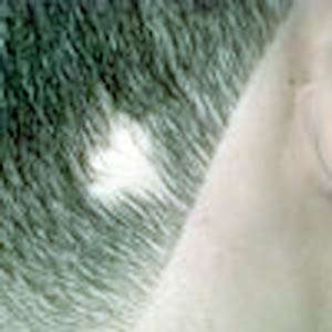 آلوپسی چیست؟