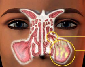 علائم عفونت سینوس