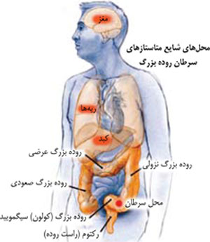 سرطان روده بزرگ