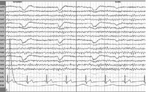 نوار مغز یا انسفالوگرام ( EEG )