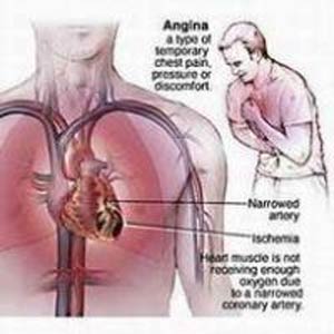 درد قفسه سینه 