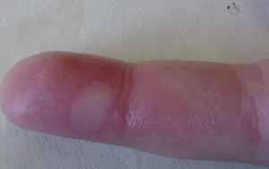 کمک به التیام تاول