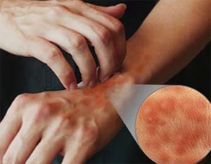 درمان کهیر مزمن آسان نیست