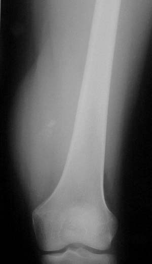 سرطان استخوان