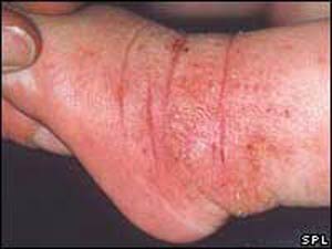 از اگزما چه می‌دانید؟