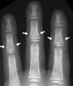 پوکی استخوان یا استئوپروز