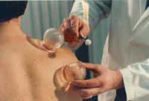 عوارض منفی حجامت‌