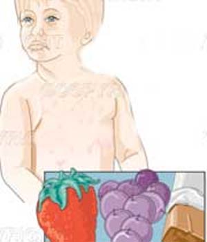 آلرژی‌ غذایی‌‌