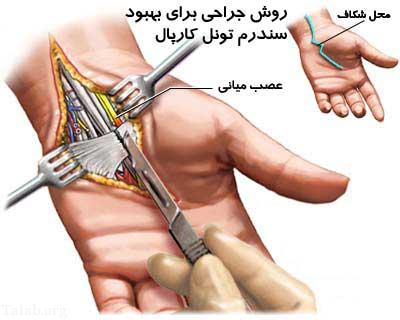 نگاهی به بیماری سندرم تونل کارپ
