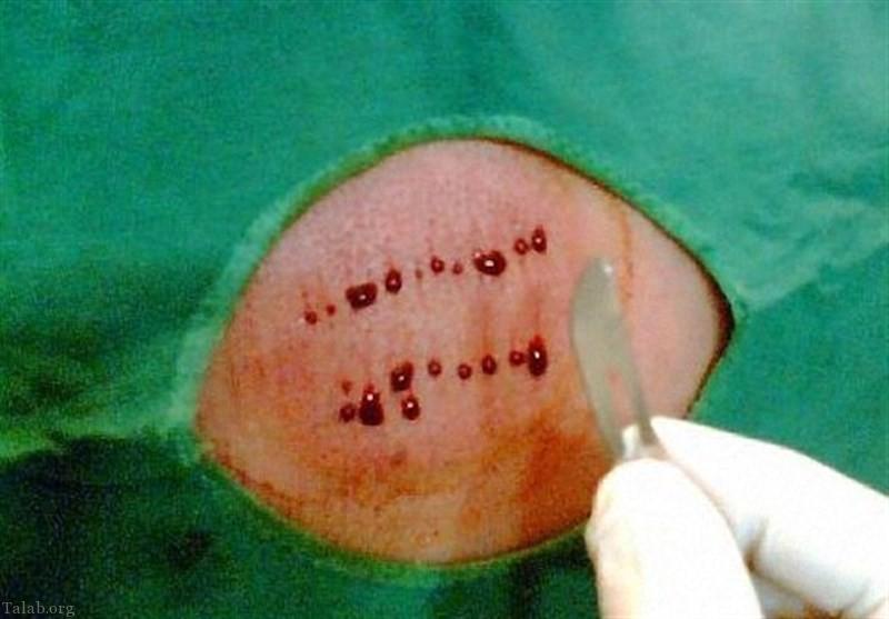 آیا با حجامت کردن آلرژی درمان میشود ؟