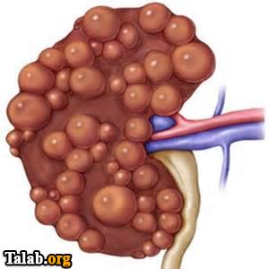 علایم و ایجاد بیماری کلیه پلی کیستیک