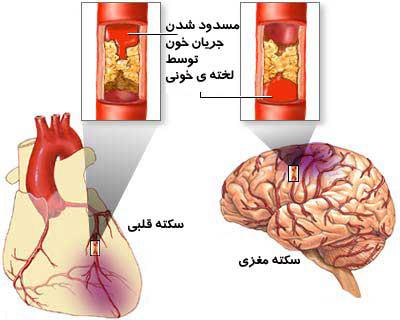 آشنایی و درک علائم ونشانه‌های سکته قلبی