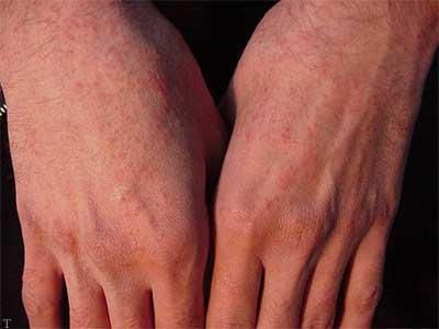 9 روش برای کاهش خارش کهیر مزمن