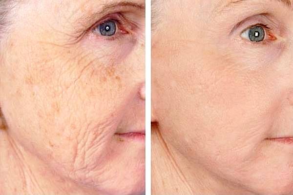 تیکسل چیست و چگونه انجام می شود ؟