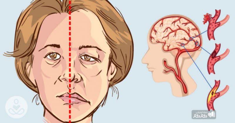 درمان سکته مغزی