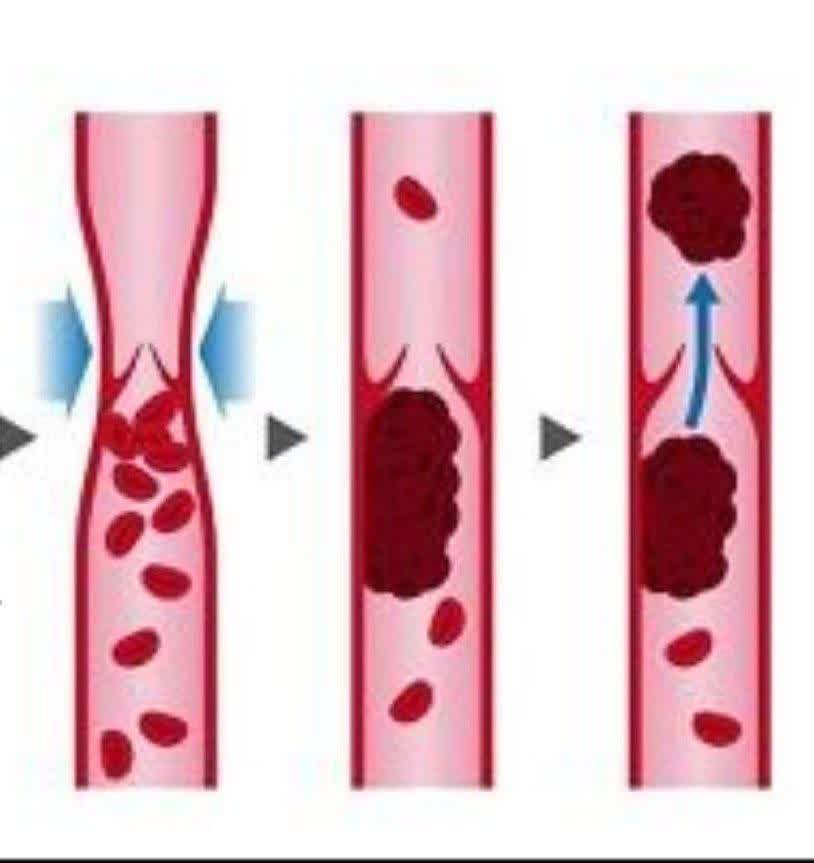 درمان لخته شدن خون