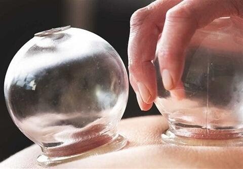 انواع حجامت