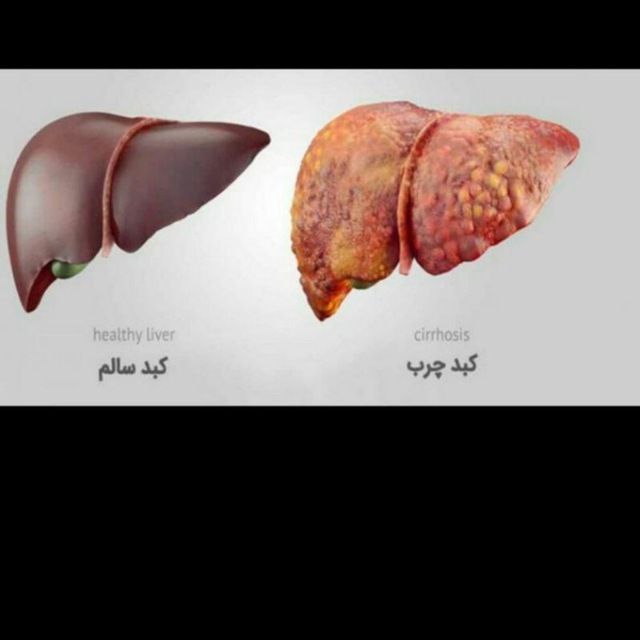 کبد چرب