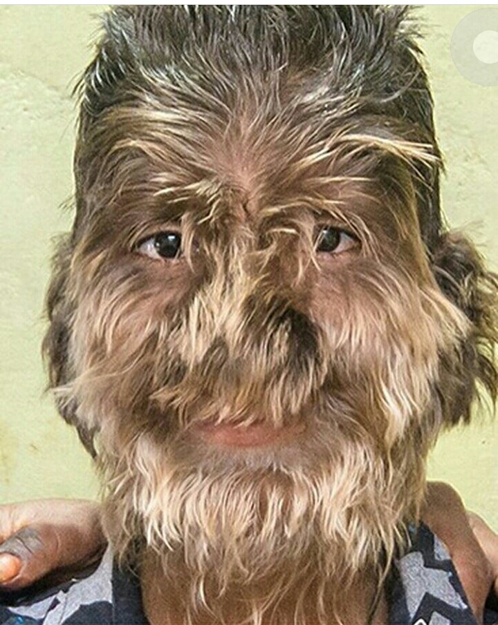 انسانهای متفاوت بابیماری سندرم پرمویی