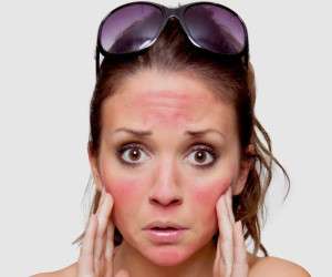 علل و درمان آفتاب سوختگی