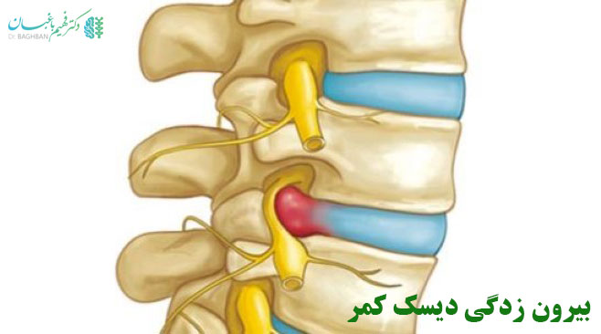 علائم و درمان دیسک کمر