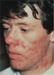 جوشها اخطاری برای بیماریها