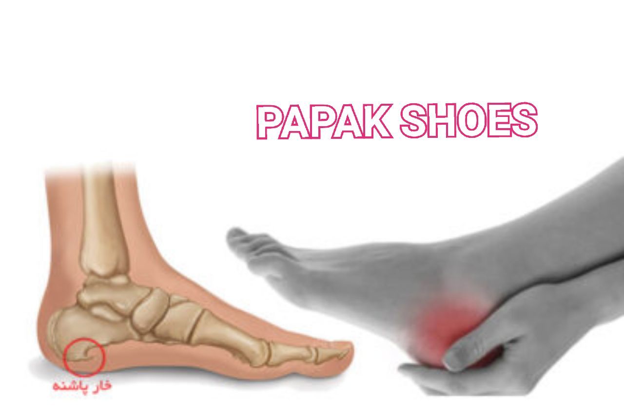 خار پاشنه  چیست؟